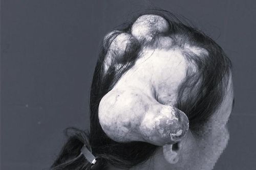 Căn bệnh khiến người phụ nữ 'mọc sừng' kỳ lạ trên đầu