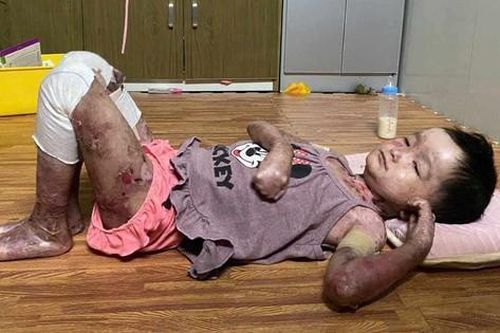 Bé gái 8 tuổi toàn thân lở loét, tứa máu vì căn bệnh quái ác