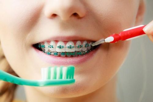 Một số lưu ý khi niềng răng để hàm răng luôn trắng khỏe