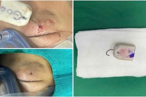 Bé trai 8 tuổi bị móc câu móc vào mi mắt khi đi câu cá cùng gia đình