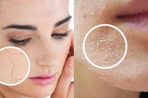 Cách khắc phục, chăm sóc da khô sần
