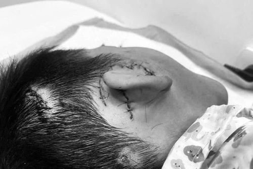 Bé trai 8 tuổi bị chó cắn suýt đứt rời tai