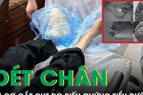 Biến chứng bệnh tiểu đường, người đàn ông bị loét chân, nguy cơ phải cắt cụt