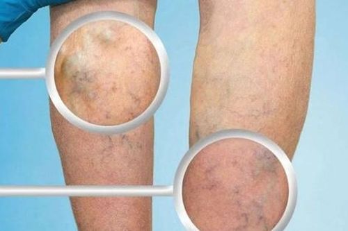 Viêm tắc tĩnh mạch chân có nguy hiểm không?