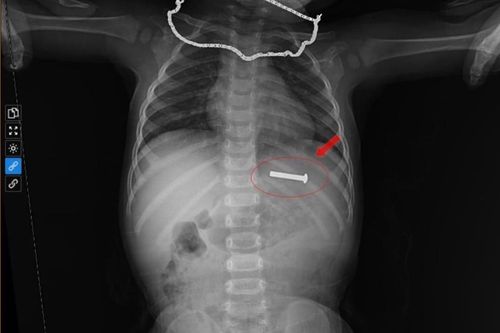 Gắp thành công đinh vít dài 5cm ra khỏi dạ dày bệnh nhi 15 tháng tuổi