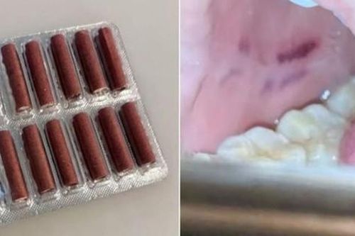 Cắn nhầm pháo nổ, người phụ nữ bị bỏng miệng