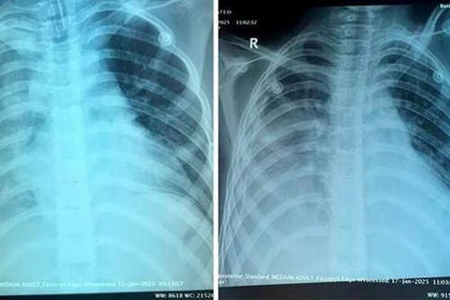20 ngày giành lại sự sống cho bệnh nhi Ấn Độ bị viêm phổi hoại tử