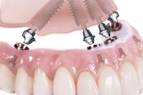 Cách phục hình hàm cho người mất răng toàn hàm