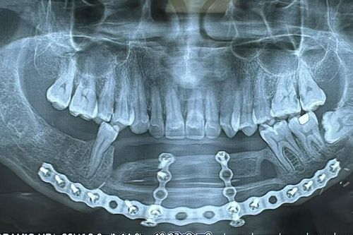 Tìm lại nụ cười bằng cấy ghép implant trên xương mác