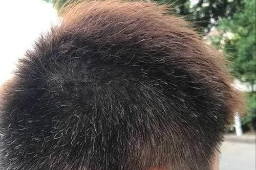 Tóc bạc mọc ở đâu, bệnh tật sẽ đến từ đó? Nếu mọc ở trán, thái dương, sau đầu thì có nghĩa là gì?