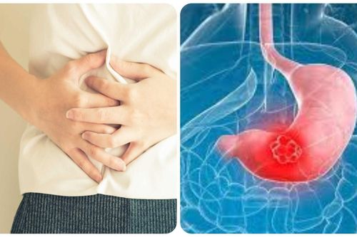 7 dấu hiệu ung thư dạ dày thường gặp