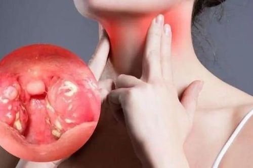 Biến chứng đáng sợ của viêm họng khi trời lạnh, dấu hiệu cần gặp bác sĩ gấp