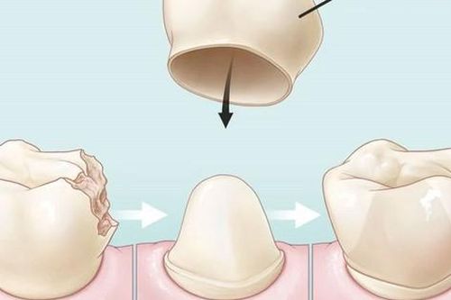 Cách nào hạn chế răng sứ xỉn màu?