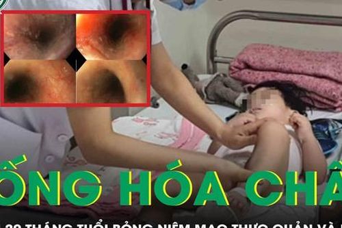 Uống nhầm hóa chất, bé gái 20 tháng tuổi suy hô hấp, hoại tử niêm mạc