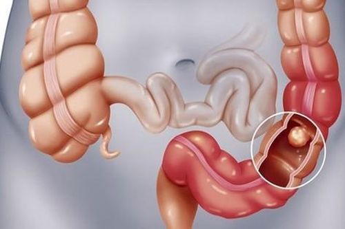 Đau bụng, đầy hơi… cảnh giác với viêm túi thừa manh tràng