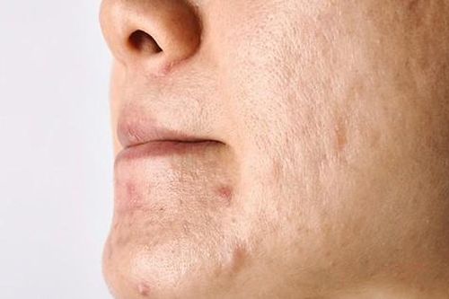Sẹo mụn điều trị thế nào?