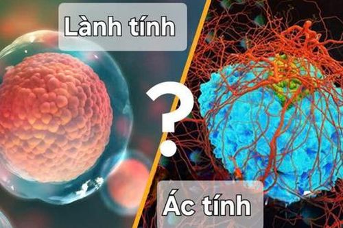 Khối u lành tính có thể phát triển thành ác tính không?