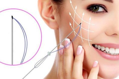 Cấy chỉ thẩm mỹ giúp làm đẹp da như thế nào?