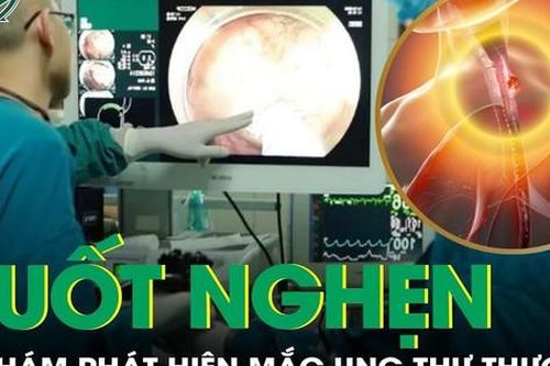 Khó nuốt kéo dài sau tết, người đàn ông phát hiện ung thư thực quản
