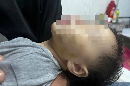 Thông tin vụ bé gái 9 tháng tuổi bị bầm tím ở má tại một điểm giữ trẻ