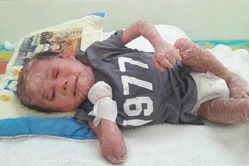 Bé trai 2 tuổi không có tinh hoàn, toàn thân nứt nẻ vì căn bệnh quái ác khiến ai nhìn cũng xót xa
