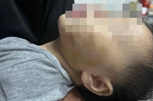 Xung quanh vụ bé gái 9 tháng tuổi ở Đắk Lắk phải nhập viện sau khi gửi nhà trẻ