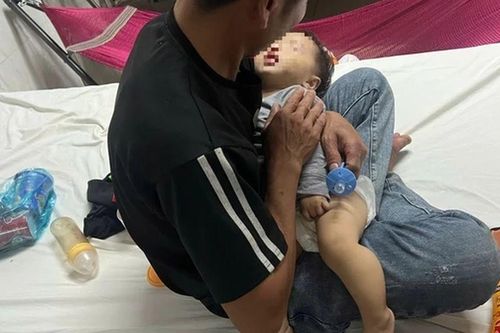 Bé 9 tháng tuổi bầm tím 2 má nghi bị đánh tại điểm trông trẻ