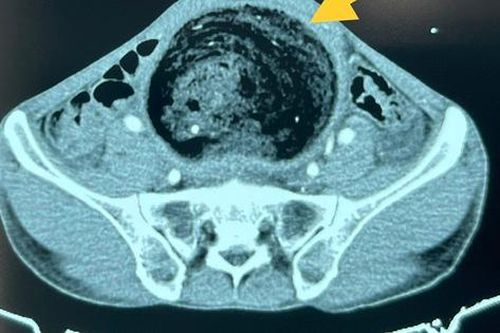 Người đàn ông bụng to như chửa sau 3 năm thường xuyên bị táo bón