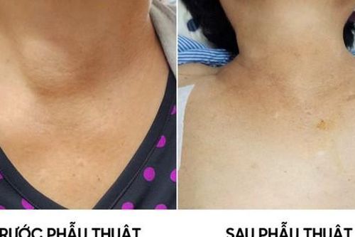 Người phụ nữ 59 tuổi phát hiệu u tuyến giáp từ dấu hiệu nhiều người Việt bỏ qua
