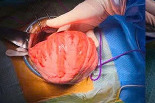Người đàn ông 'chửa phân' do mắc căn bệnh bẩm sinh phức tạp