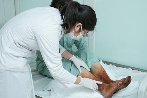 Hoại tử hai chân vì ngâm bột lá giữ ấm cơ thể