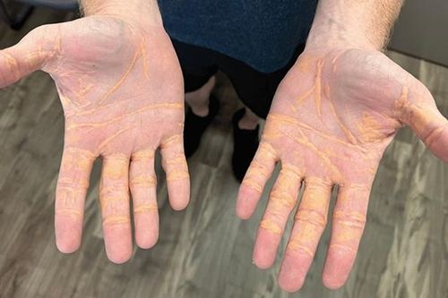 Hình ảnh bàn tay kỳ lạ của người đàn ông chỉ ăn thịt