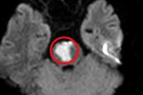 Thiếu niên 17 tuổi bị đột quỵ não sau cơn đau đầu, chóng mặt