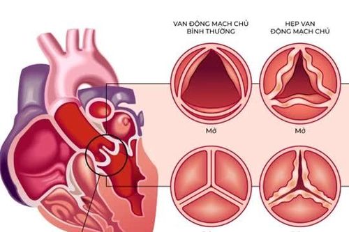 Bệnh viện FV ứng dụng công nghệ thay van động mạch chủ thế hệ mới nhất