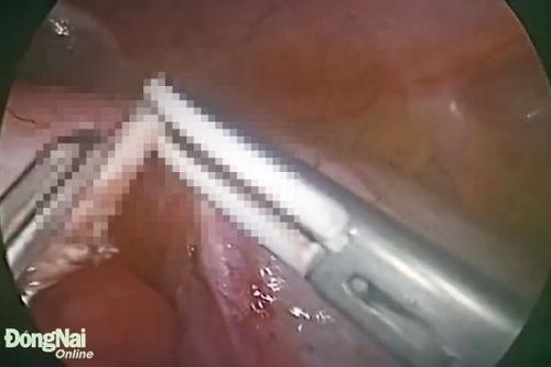 Một nam bệnh nhân ở Long Khánh bị hội chứng 'bụng đóng kén' gây tắc ruột hiếm gặp