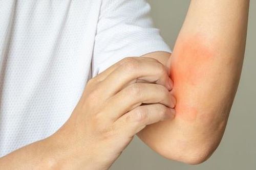 Dị ứng thức ăn làm sao để nhận biết?