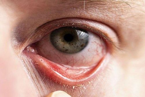 6 biện pháp phòng ngừa dị ứng mắt