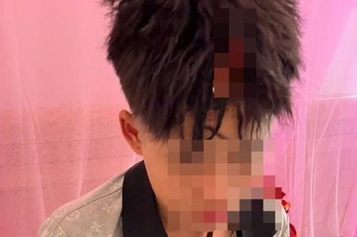 Đang nằm võng, nam sinh lớp 10 ở Đắk Lắk bị đánh vỡ đầu, gãy tay