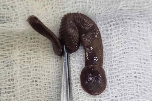 Gắp thành công con vắt dài 8 cm trong mũi nam bệnh nhân