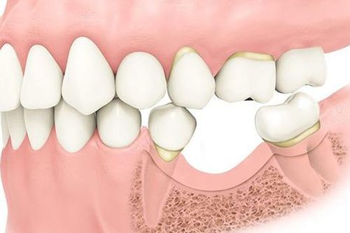 Ai cần ghép xương trong cấy ghép implant?