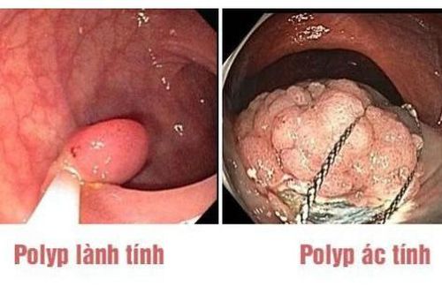 5 triệu chứng cho thấy bạn mắc polyp đại tràng