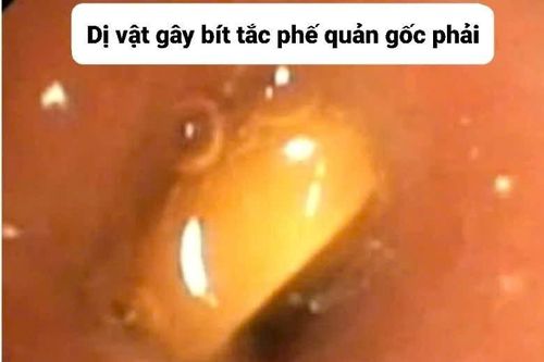 Xử lý nhiều ca bệnh nhi hóc dị vật