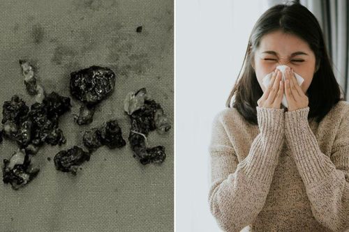 Liên tục ngửi thấy mùi hôi, người phụ nữ giật mình khi phát hiện thứ kỳ lạ này trong mũi