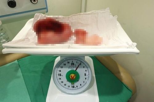 Tập thể dục đều đặn vẫn 'béo bụng', người phụ nữ 40 tuổi bất ngờ khi biết nguyên nhân