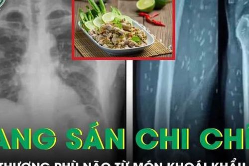 Tổn thương phù não gây co giật, méo miệng vì nang sán chi chít khắp cơ thể