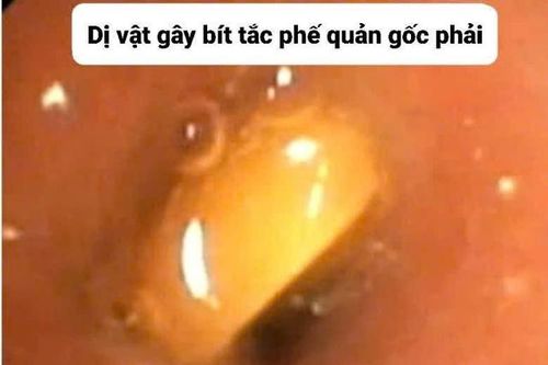 Liên tục tiếp nhận nhiều bệnh nhi hóc dị vật