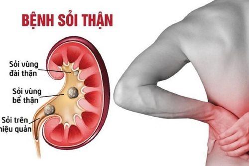 Thói quen xấu của dân văn phòng dễ gây sỏi thận