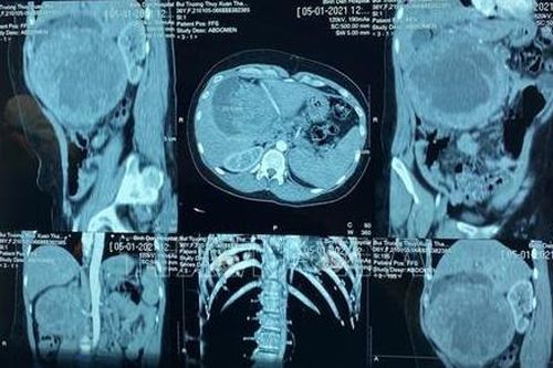 Tiến bộ quan trọng trong chẩn đoán và điều trị ung thư tuyến tụy