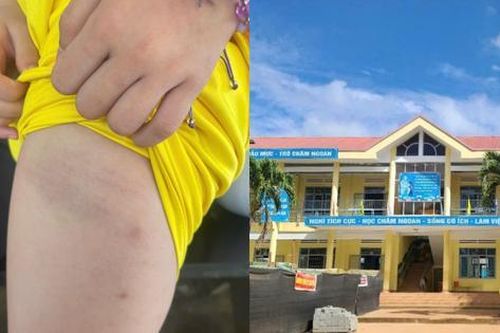 Một giáo viên Tiểu học tại Đắk Lắk thừa nhận dùng dây điện để đánh học sinh