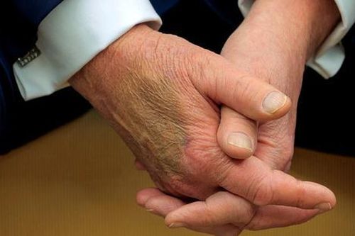 Xuất hiện vết bầm gây bàn tán trên tay Tổng thống Trump